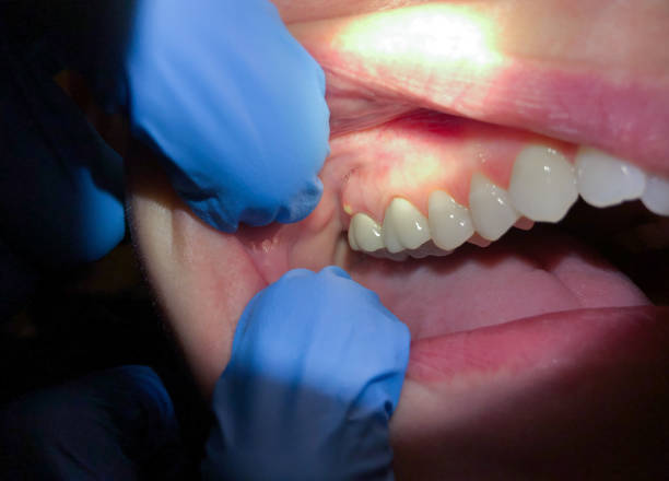 Best Broken or Cracked Tooth Emergency Dentist in Batavia, OH